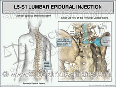 This medical exhibit depicts an L5-S1 lumbar epidural steroid injection on a female patient for pain management treatment of L5-S1 lumbar disc injury. The exhibit shows a transparent female figure orientation view on the left with a close up posterior view of the epidural steroid injection procedure with lumbar spine anatomy in detail on the right, with descriptive labels.