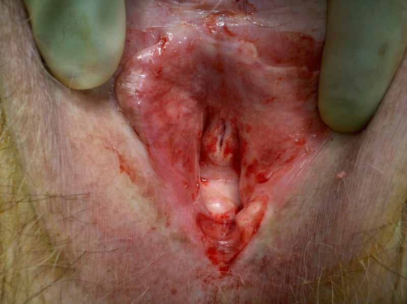 Lichen Sclerosus et Atrophicus (lichen sclerosus [preferred term], lichen  planus atrophicus, lichen planus sclerosus, kraurosis vulva, balanitis  xerotica obliterans, vulvar dystrophy)