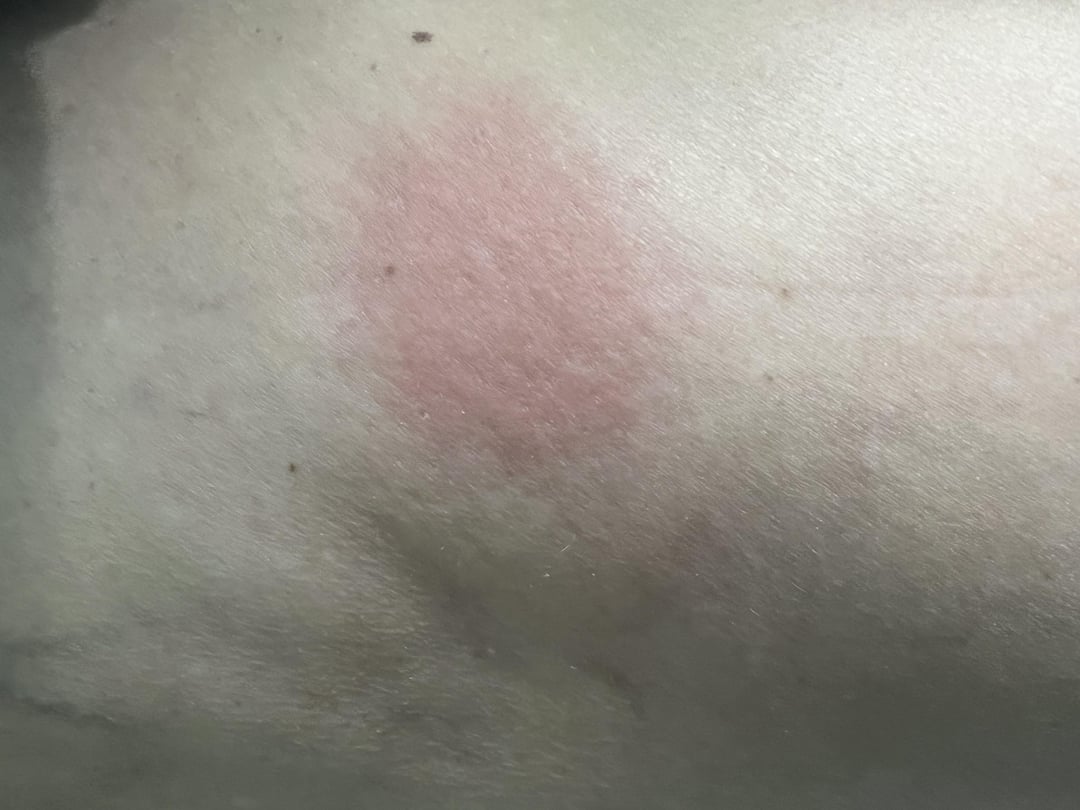 Injection site reaction -anyone else? : r/Zepbound