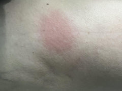 Injection site reaction -anyone else? : r/Zepbound