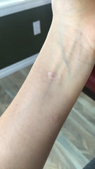 burn marks from cigarette How can I get rid of cigarette burns on my  forearm? I've tried scar gels and creams and nothing has helped. (photos)